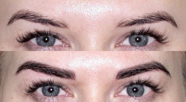 mikroblejding-brovej-pri-beremennosti1