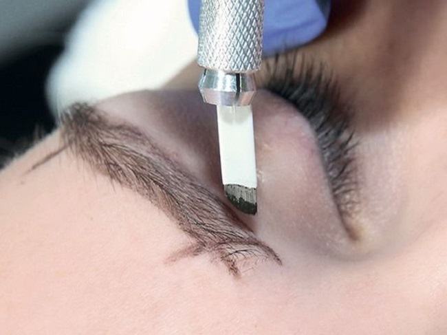 mikroblejding-brovej-pri-beremennosti3