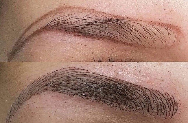 mikroblejding-brovej-pri-beremennosti4