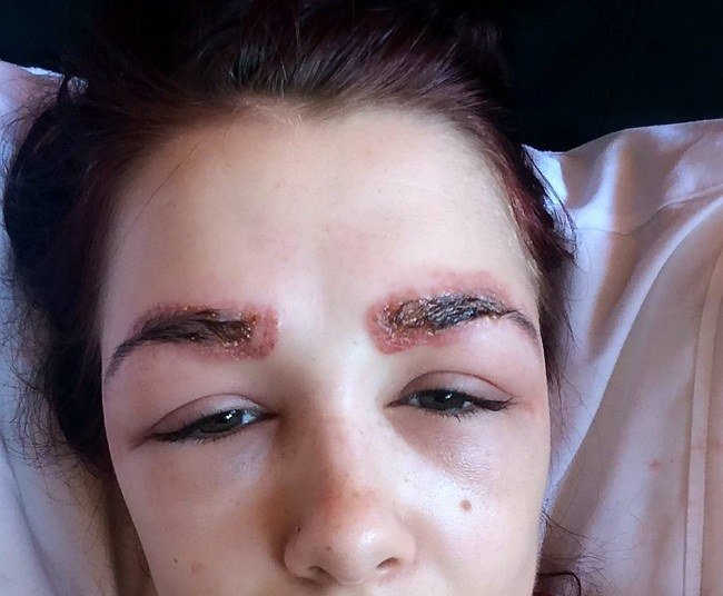 allergiya-na-hnu-dlya-brovej-ot-prichin-k-lecheniyu1