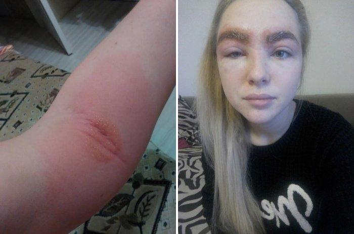 allergiya-na-hnu-dlya-brovej-ot-prichin-k-lecheniyu10