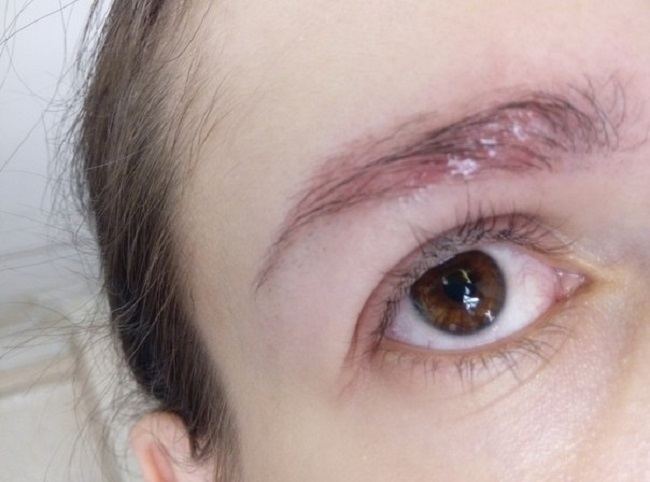 allergiya-na-hnu-dlya-brovej-ot-prichin-k-lecheniyu2