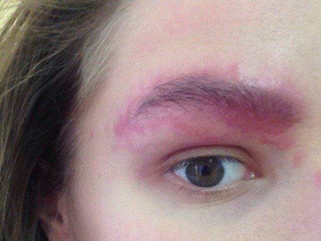 allergiya-na-hnu-dlya-brovej-ot-prichin-k-lecheniyu3