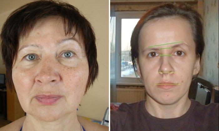 odna-brov-vyshe-drugoj-prichiny-disproporcii3