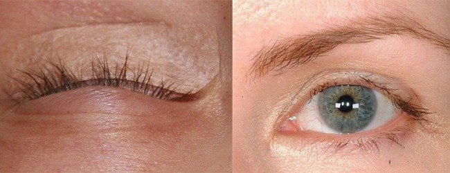 prichiny-vypadeniya-resnic-vozvrashchaem-byluyu-krasotu2
