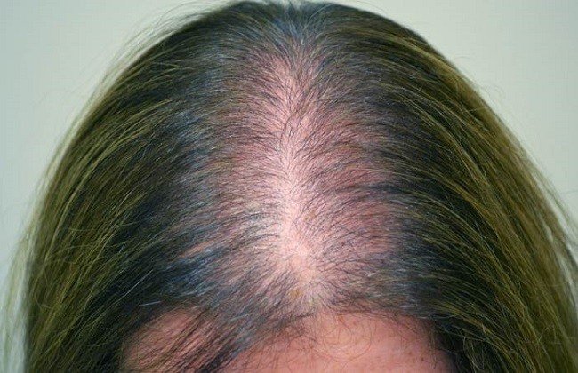 narodnye-sredstva-ot-vypadeniya-i-issusheniya-volos6