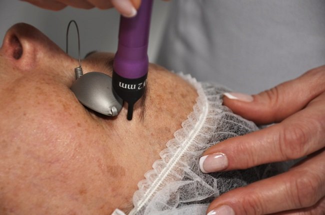 preimushchestva-lazernoj-ehpilyacii-brovej1