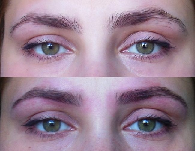 preimushchestva-lazernoj-ehpilyacii-brovej10