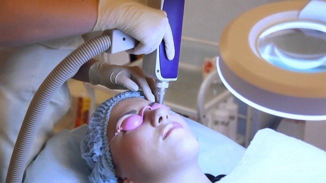 preimushchestva-lazernoj-ehpilyacii-brovej4