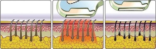preimushchestva-lazernoj-ehpilyacii-brovej5