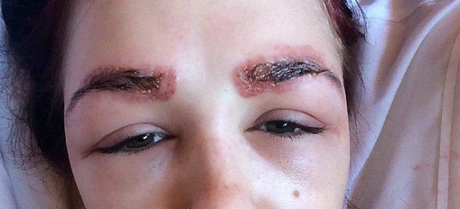 prichiny-i-lechenie-vypadeniya-brovej3