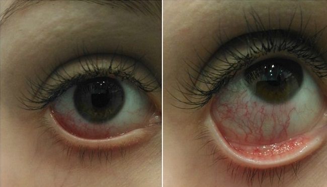 prichiny-krasnyh-glaz-posle-narashchivaniya-resnic1